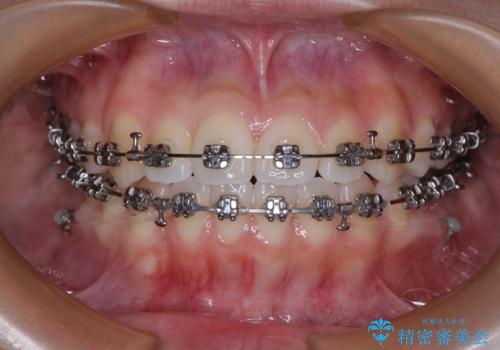 前歯のデコボコを楽して改善 ワイヤー装置による矯正治療の治療中