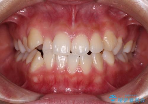 前歯のデコボコを楽して改善 ワイヤー装置による矯正治療の治療前