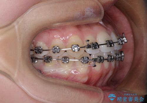 前歯のデコボコを楽して改善 ワイヤー装置による矯正治療の治療中