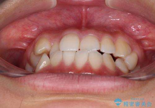 前歯のデコボコを楽して改善 ワイヤー装置による矯正治療の治療前