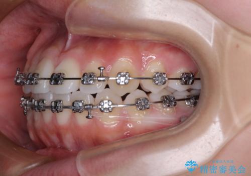 前歯のデコボコを楽して改善 ワイヤー装置による矯正治療の治療中