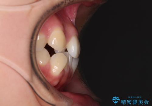 前歯のデコボコを楽して改善 ワイヤー装置による矯正治療の治療前