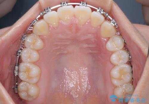 前歯のデコボコを楽して改善 ワイヤー装置による矯正治療の治療中