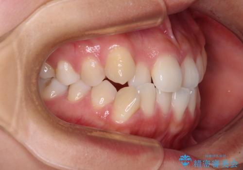 前歯のデコボコを楽して改善 ワイヤー装置による矯正治療の治療前