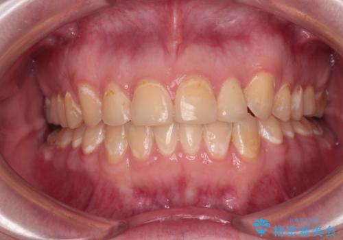 前歯のクロスバイトを改善　ワイヤー矯正を併用したインビザライン矯正の症例 治療後
