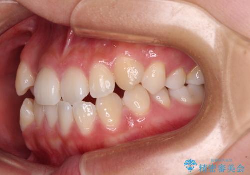 前歯のデコボコを楽して改善 ワイヤー装置による矯正治療の治療前