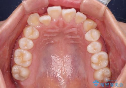 前歯のデコボコを楽して改善 ワイヤー装置による矯正治療の治療前