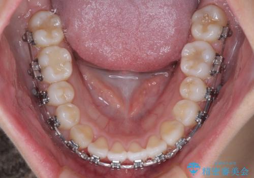 前歯のデコボコを楽して改善 ワイヤー装置による矯正治療の治療中