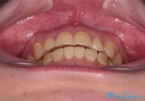 前歯のクロスバイトを改善　ワイヤー矯正を併用したインビザライン矯正の治療後