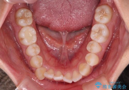 前歯のデコボコを楽して改善 ワイヤー装置による矯正治療の治療前