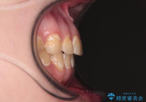 前歯のクロスバイトを改善 ワイヤー矯正を併用したインビザライン矯正の治療後