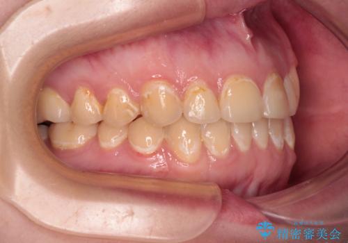 前歯のクロスバイトを改善 ワイヤー矯正を併用したインビザライン矯正の治療後