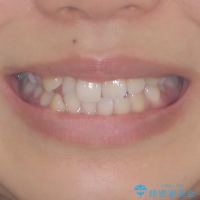 前歯のデコボコを楽して改善　ワイヤー装置による矯正治療の治療前（顔貌）