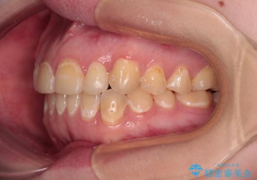 前歯のクロスバイトを改善 ワイヤー矯正を併用したインビザライン矯正の治療後