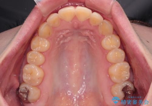 前歯のクロスバイトを改善 ワイヤー矯正を併用したインビザライン矯正の治療後