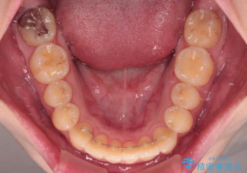 前歯のクロスバイトを改善 ワイヤー矯正を併用したインビザライン矯正の治療後