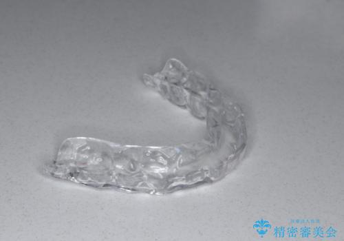 奥歯が欠けた セラミックインレーでの修復後、ナイトガード装着の治療中