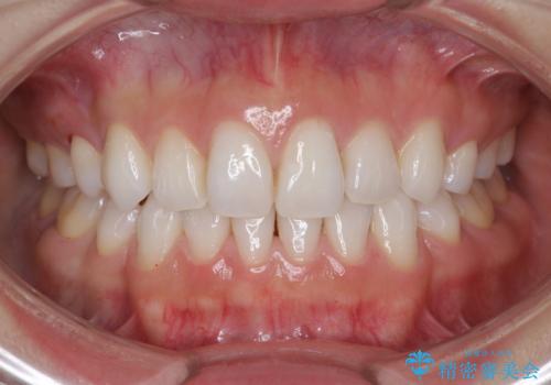 奥歯が欠けた セラミックインレーでの修復後、ナイトガード装着の治療前