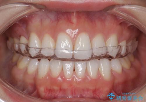 奥歯が欠けた セラミックインレーでの修復後、ナイトガード装着の治療後