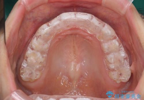 奥歯が欠けた セラミックインレーでの修復後、ナイトガード装着の治療後