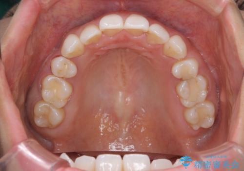 奥歯が欠けた セラミックインレーでの修復後、ナイトガード装着の治療前