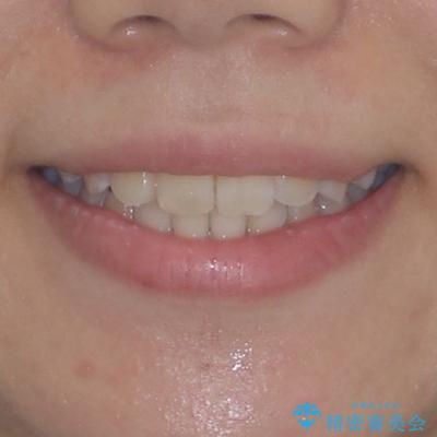 前歯のデコボコと隠れてしまう下顎前歯 インビザラインですっきりと改善の治療後(顔貌)