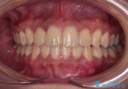 前歯のデコボコと隠れてしまう下顎前歯　インビザラインですっきりと改善