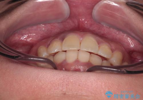 前歯のデコボコと隠れてしまう下顎前歯 インビザラインですっきりと改善の治療後