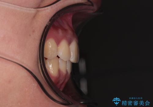 前歯のデコボコと隠れてしまう下顎前歯　インビザラインですっきりと改善の治療後