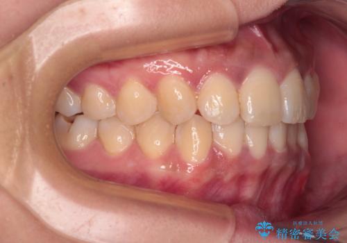 前歯のデコボコと隠れてしまう下顎前歯　インビザラインですっきりと改善の治療後