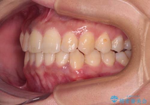 前歯のデコボコと隠れてしまう下顎前歯 インビザラインですっきりと改善の治療後