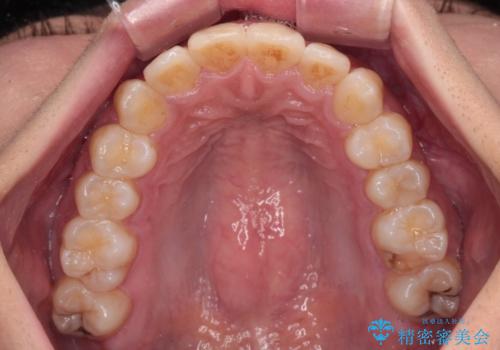 前歯のデコボコと隠れてしまう下顎前歯 インビザラインですっきりと改善の治療後