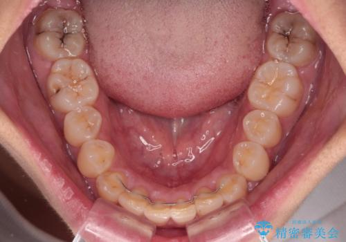 前歯のデコボコと隠れてしまう下顎前歯 インビザラインですっきりと改善の治療後