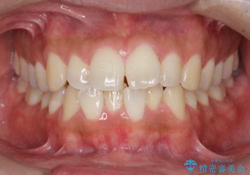 マウスピース矯正で前歯の見た目を治したいの症例 治療前