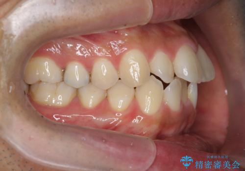 マウスピース矯正で前歯の見た目を治したいの治療前