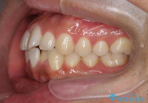 マウスピース矯正で前歯の見た目を治したいの治療前