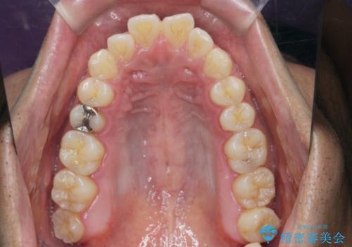 マウスピース矯正で前歯の見た目を治したいの治療前