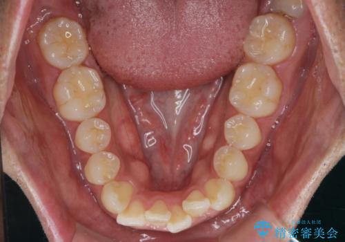 マウスピース矯正で前歯の見た目を治したいの治療前