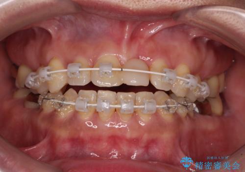 中途半端な矯正治療と前歯の欠損　再矯正とオールセラミッククラウンによる補綴治療の治療中