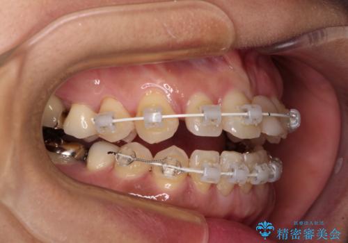 中途半端な矯正治療と前歯の欠損 再矯正とオールセラミッククラウンによる補綴治療の治療中