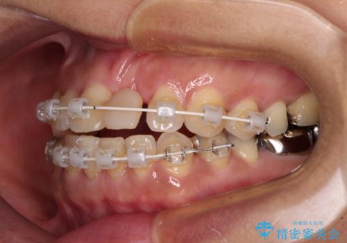 中途半端な矯正治療と前歯の欠損 再矯正とオールセラミッククラウンによる補綴治療の治療中