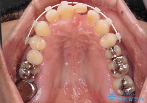 中途半端な矯正治療と前歯の欠損　再矯正とオールセラミッククラウンによる補綴治療の治療中