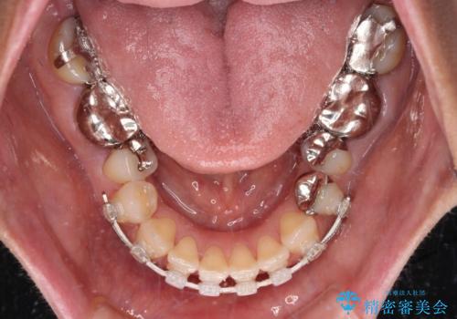 中途半端な矯正治療と前歯の欠損 再矯正とオールセラミッククラウンによる補綴治療の治療中