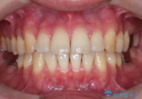 短期間で口元の印象をガラリと変えませんか? 30代男性 インビザライン矯正で自然な口元美を実現の症例 治療後