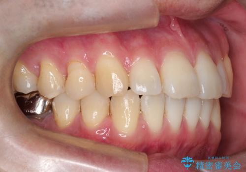 短期間で口元の印象をガラリと変えませんか? 30代男性 インビザライン矯正で自然な口元美を実現の治療後