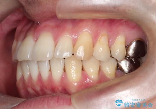 短期間で口元の印象をガラリと変えませんか? 30代男性 インビザライン矯正で自然な口元美を実現の治療後