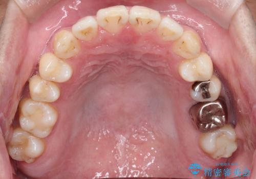 短期間で口元の印象をガラリと変えませんか? 30代男性 インビザライン矯正で自然な口元美を実現の治療後