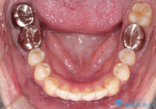 短期間で口元の印象をガラリと変えませんか? 30代男性 インビザライン矯正で自然な口元美を実現の治療後