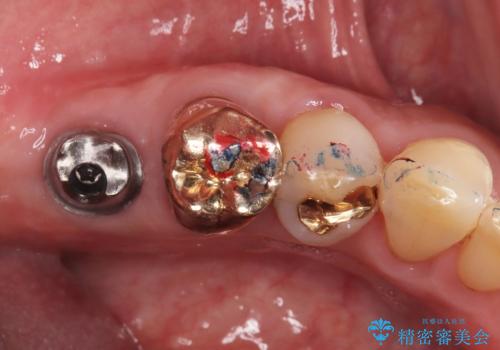 【インプラント】銀歯が取れて歯ごと折れたの治療中