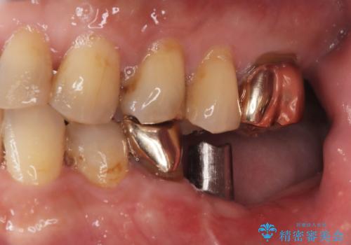 【インプラント】銀歯が取れて歯ごと折れたの治療中